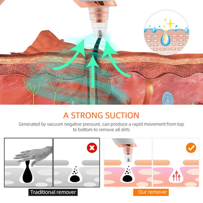 Vacuum Blackhead Remover